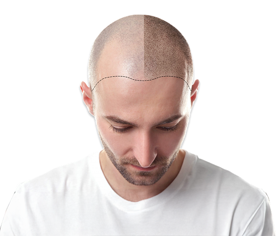 Micro Pigmentation Treatment