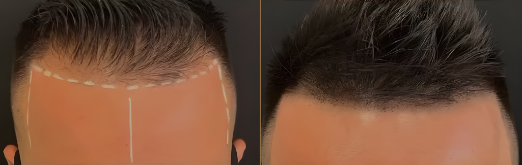 Before and After Result 1